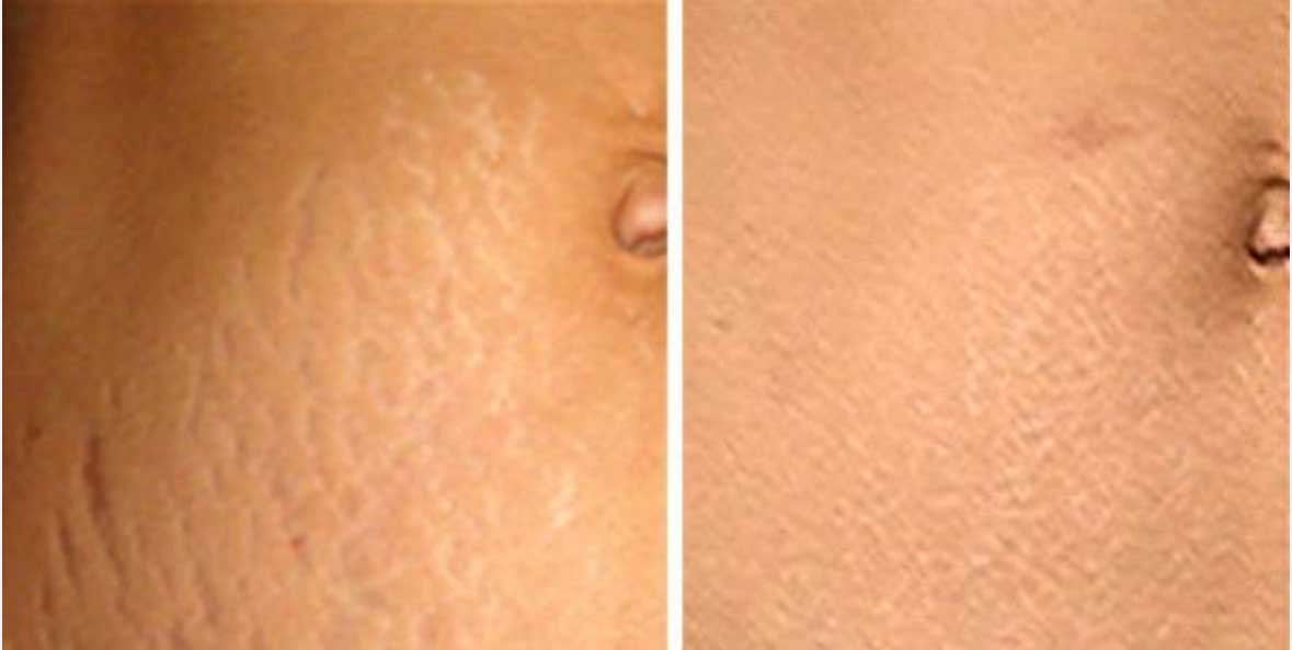 Skin Resurfacing 1st Example