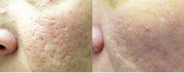 Skin Resurfacing 2nd Example